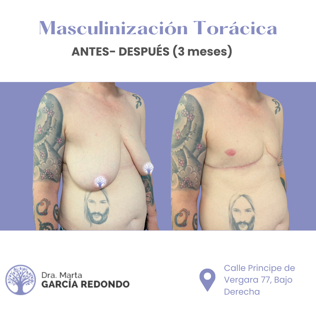Marta Garcia – 2024-11-21T101941.198 Antes y después masculinización torácica