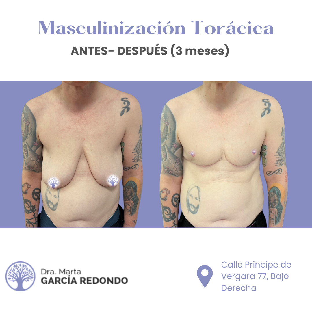 Antes y después masculinización torácica