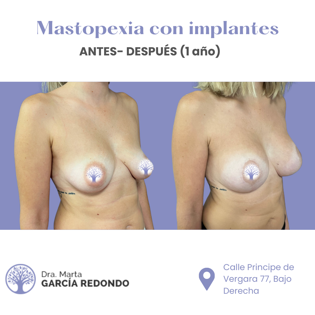 Resultados Antes y Después de Mastopexia con Implantes