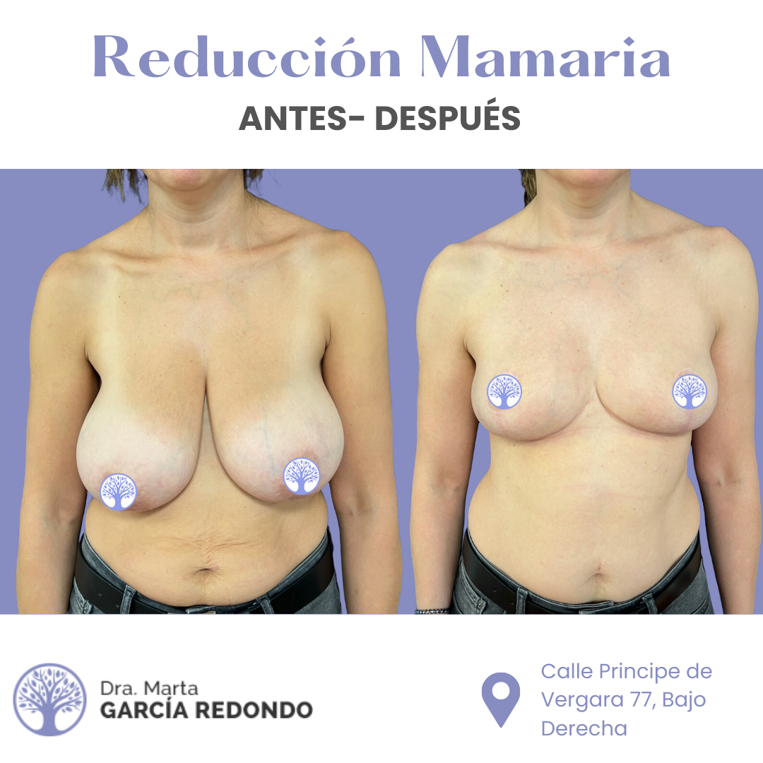 Resultados reducción Mamaria