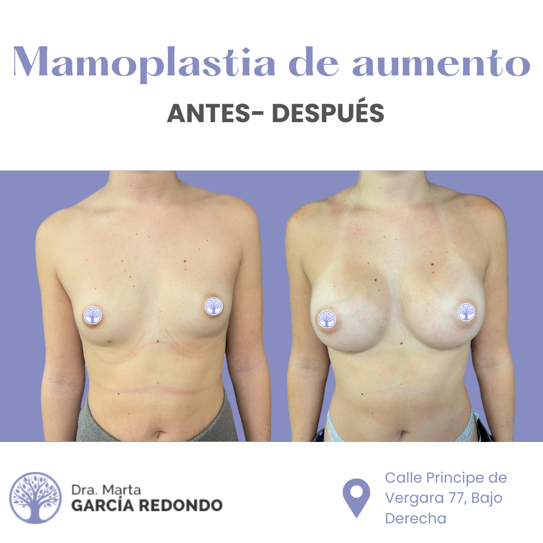 Resultados Antes y Después de Mamoplastia de aumento