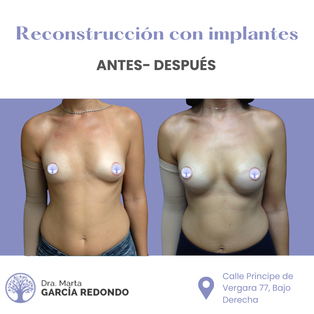 Resultados reconstrucción mamaria con implantes