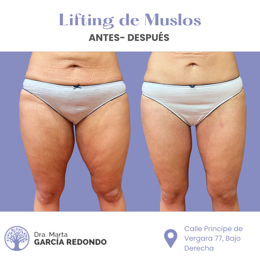 Resultados Antes y Después