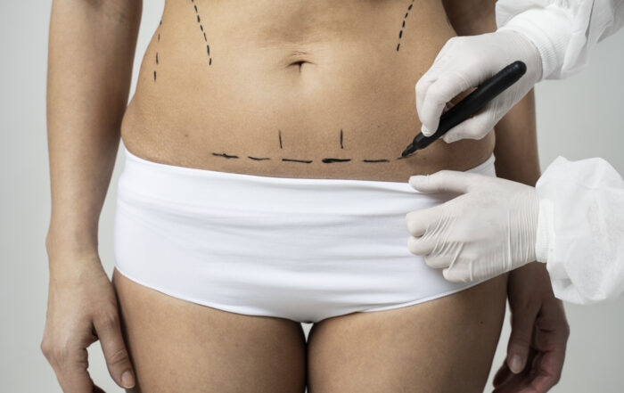 como te ayuda una Abdominoplastia